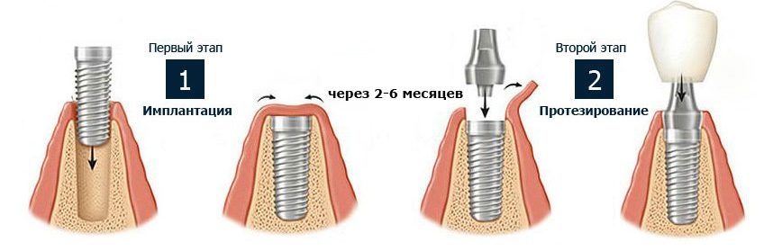 2-implant