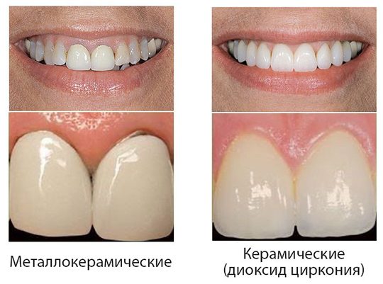 Какие-коронки-лучше