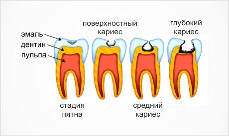 виды-кариеса