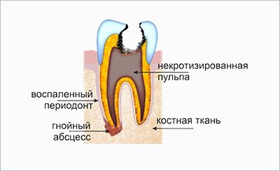 периодонтит