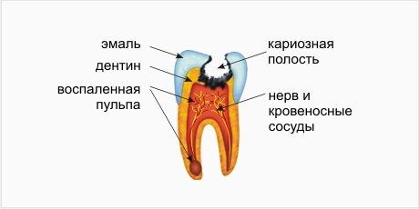 пульпит